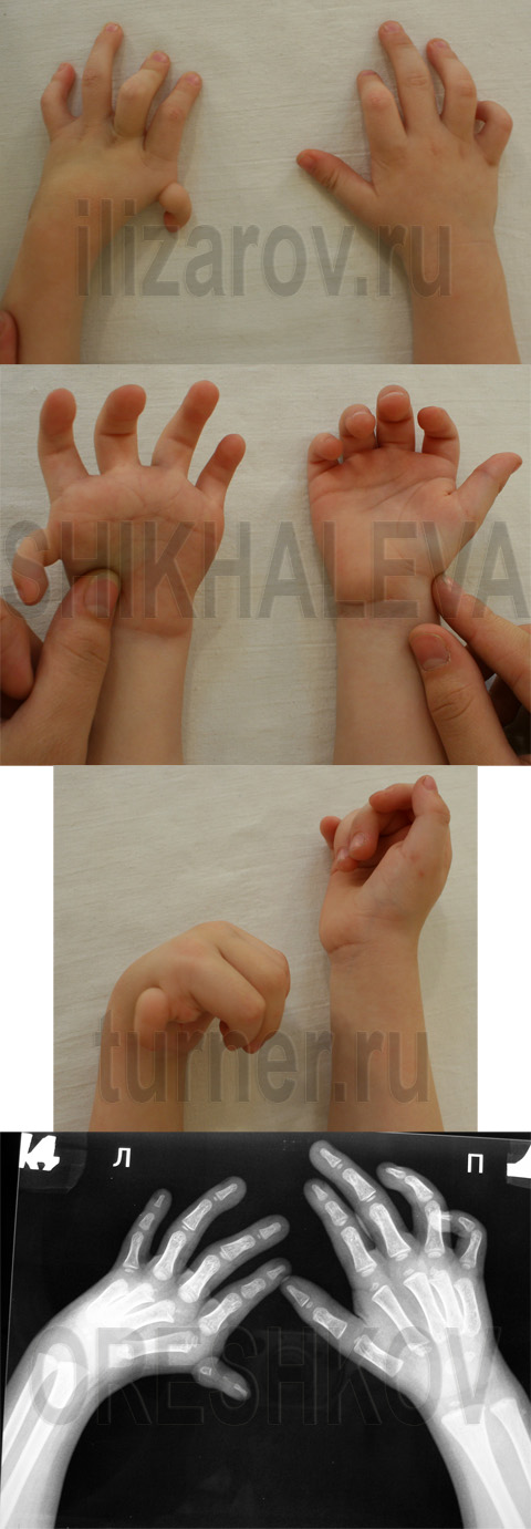Вид и рентгенограмма кистей с гипоплазией первого пальца и лучевой косорукостью левой кисти до оперативного вмешательства.