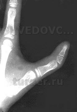 Псевдотрехфалангизм большого пальца левой кисти, имеется увеличенный в размерах эпифиз ногтевой фаланги клиновидной формы