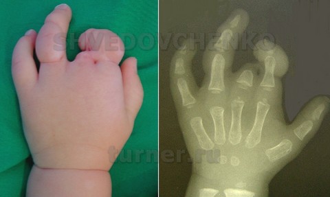Врожденные перетяжки 2 – 4 пальцев у ребенка с вторичной эктродактилией левой кисти