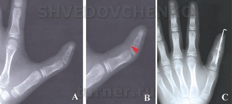 Корригирующая остеотомия в области эпифиза ногтевой фаланги при псевдотрехфалангизме.  А. вид большого пальца до вмешательства, В. cхема клиновидной резекции эпифиза, C. вид кисти после операции