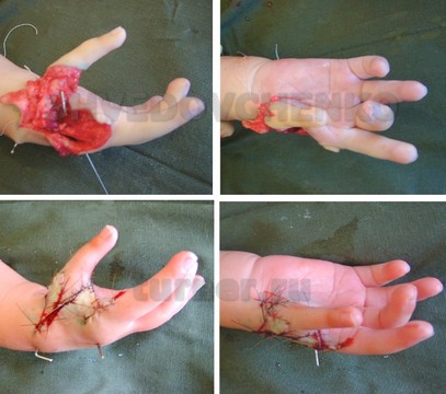 Фиксация пальца, перемещенного в позицию первого луча и состояние кисти к моменту окончания вмешательства