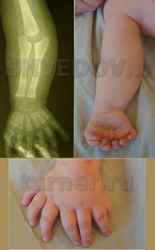 Фото и рентгенограммы верхней конечности у ребенка с удвоением локтевой кости, сочетающейся с полидактилией и трехфалангизмом большого пальца, полное отсутствие активных движений в локтевом суставе, пассивные возможных в пределах 15 градусов
